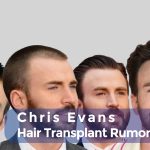 Chris Evans Hair Transplant Rumors cover