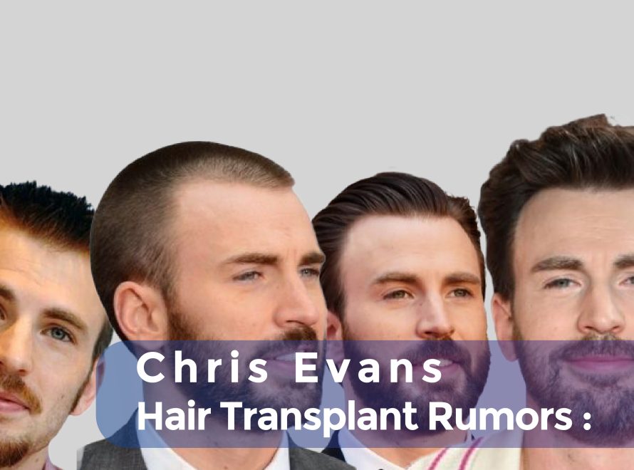 Chris Evans Hair Transplant Rumors cover