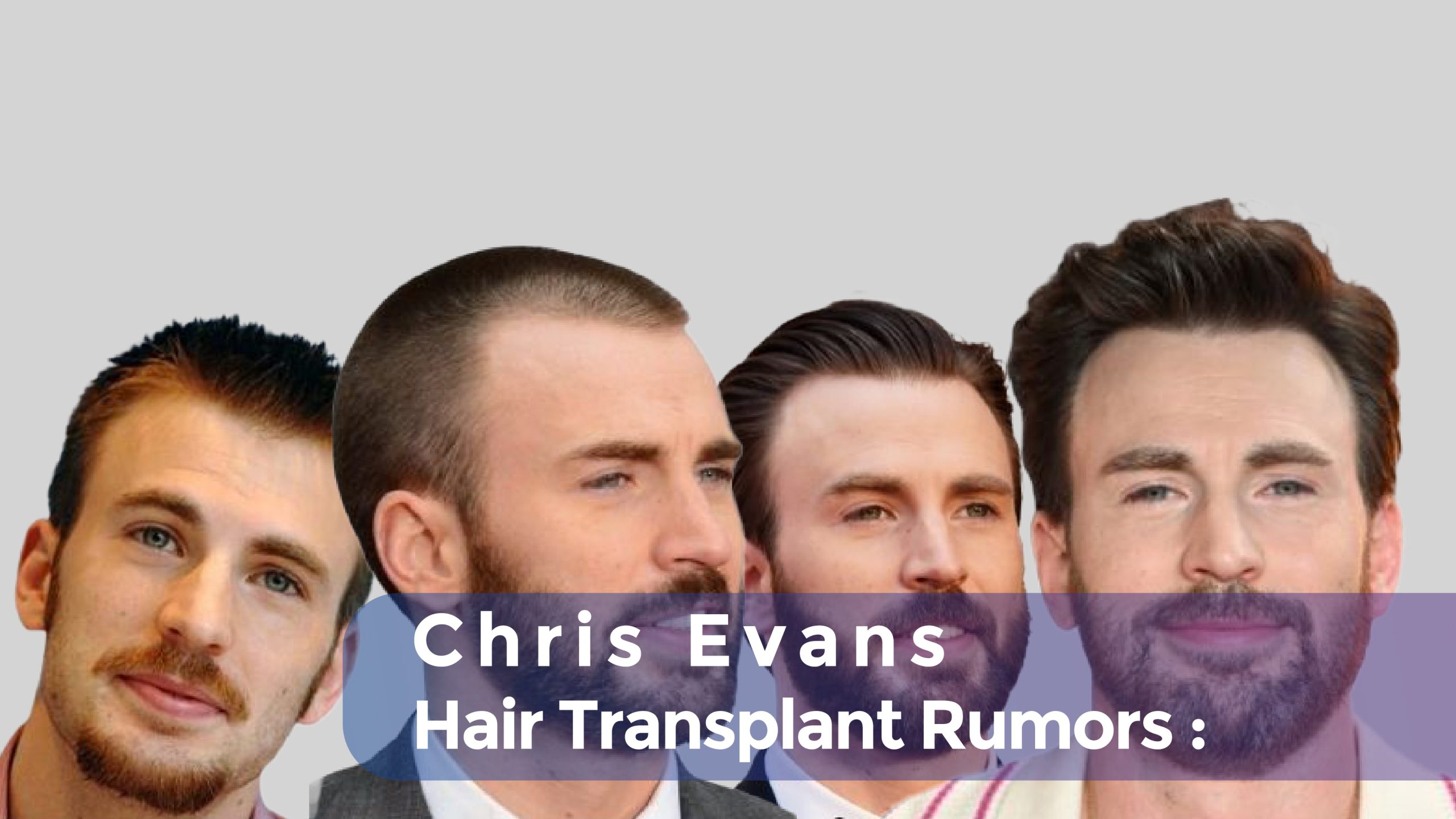 Chris Evans Hair Transplant Rumors cover