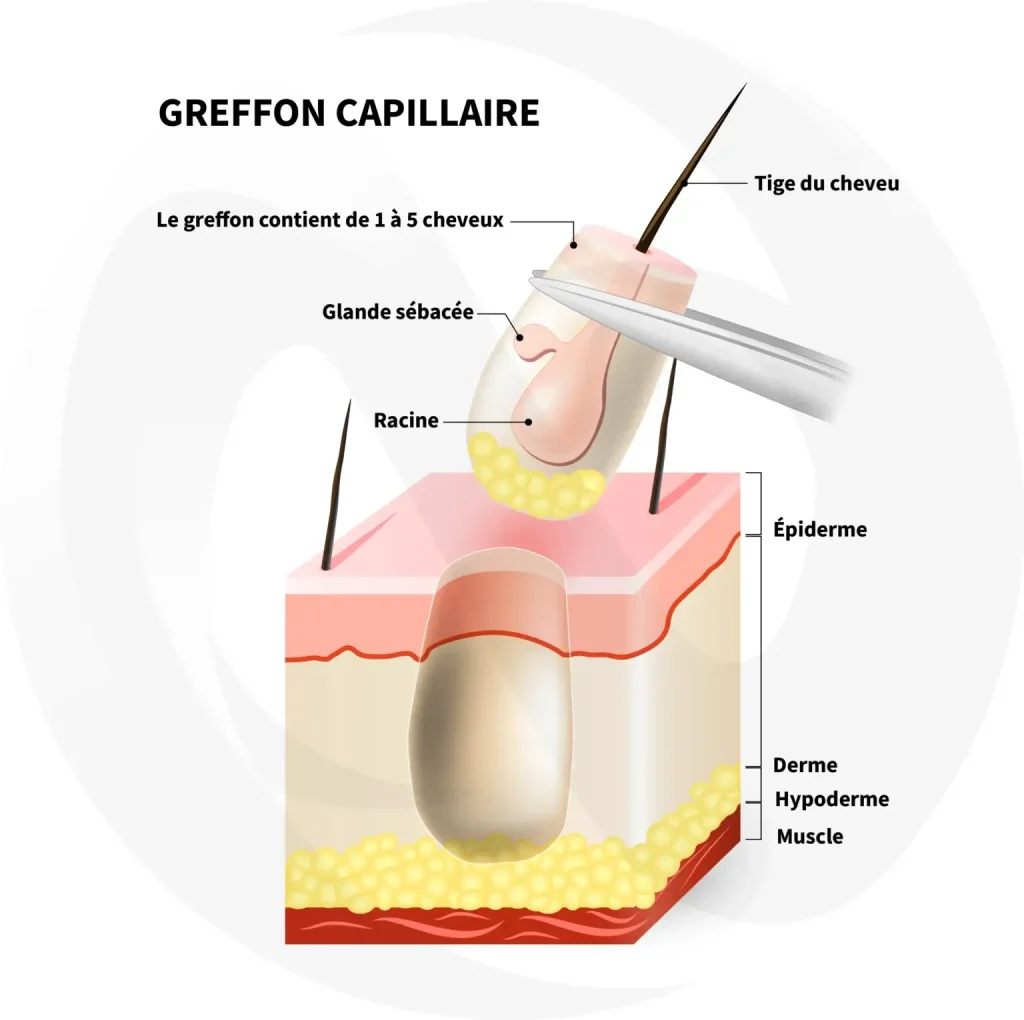 greffon dans la greffe de cheveux