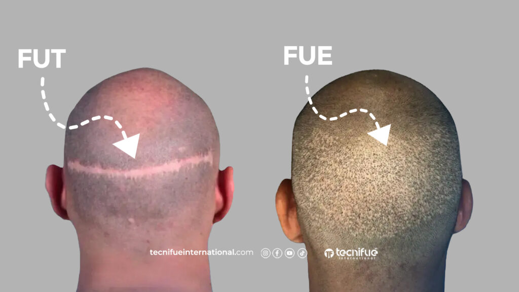 FUE and FUT donor area