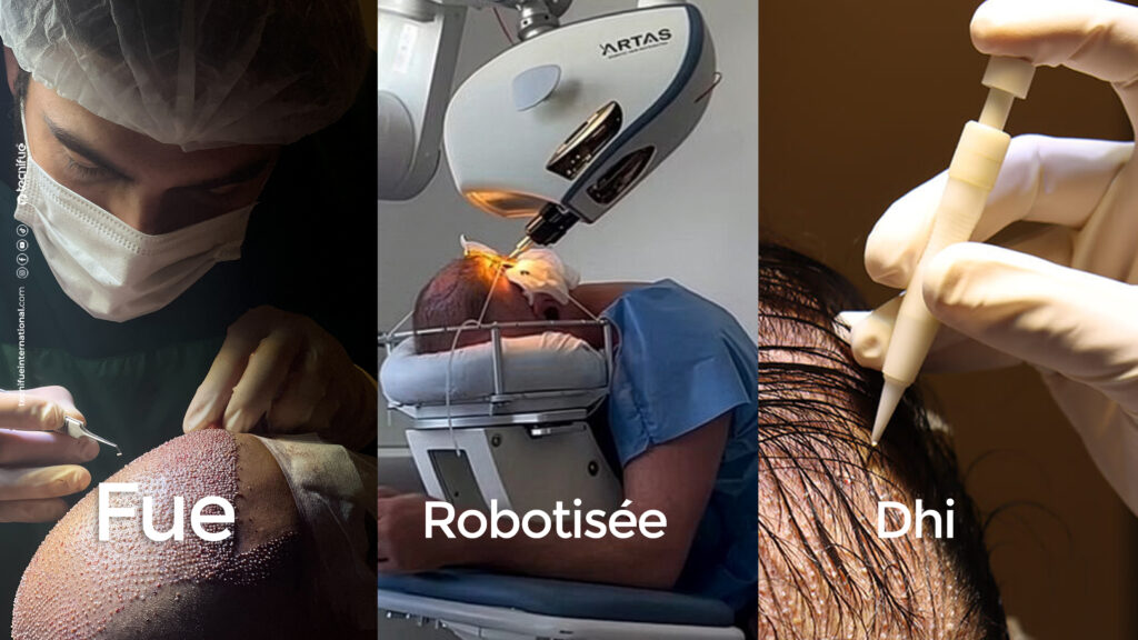 Greffe robotisée, FUE Saphir ou DHI