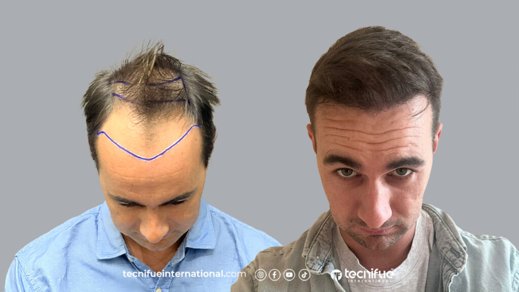 Greffe de cheveux Avant Après