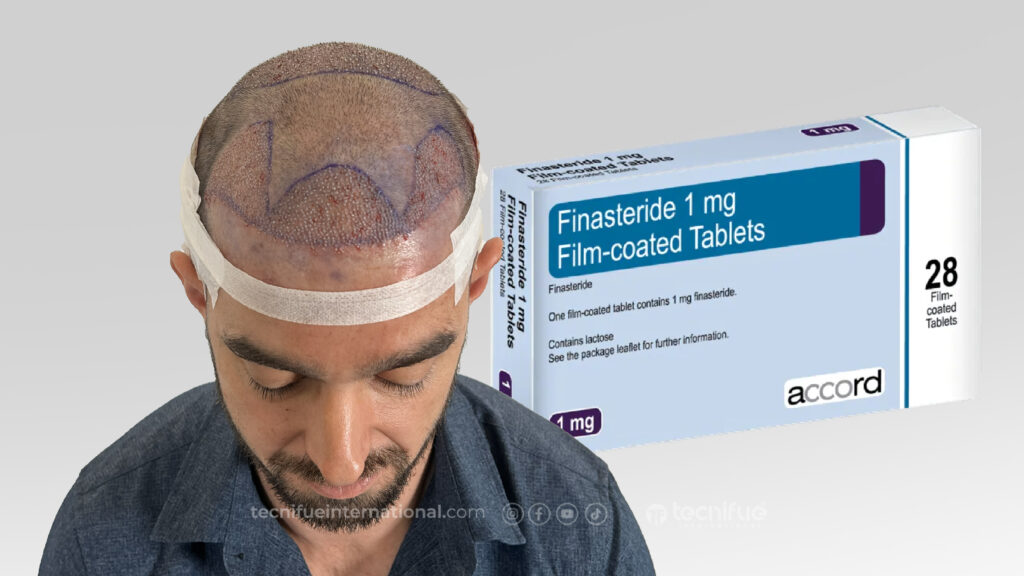 hair transplant without finasteride role