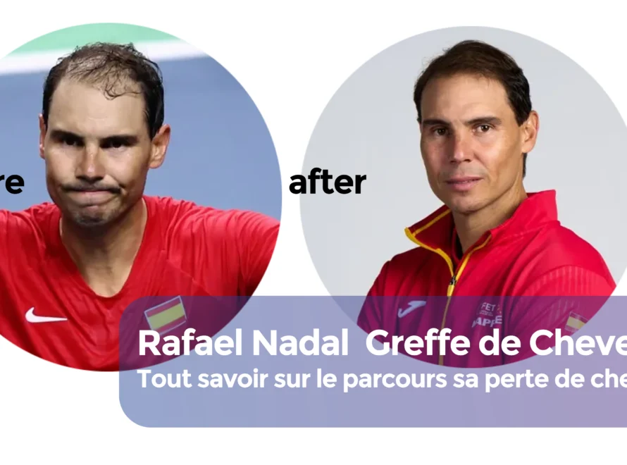 Rafael Nadal Greffe de Cheveux cover