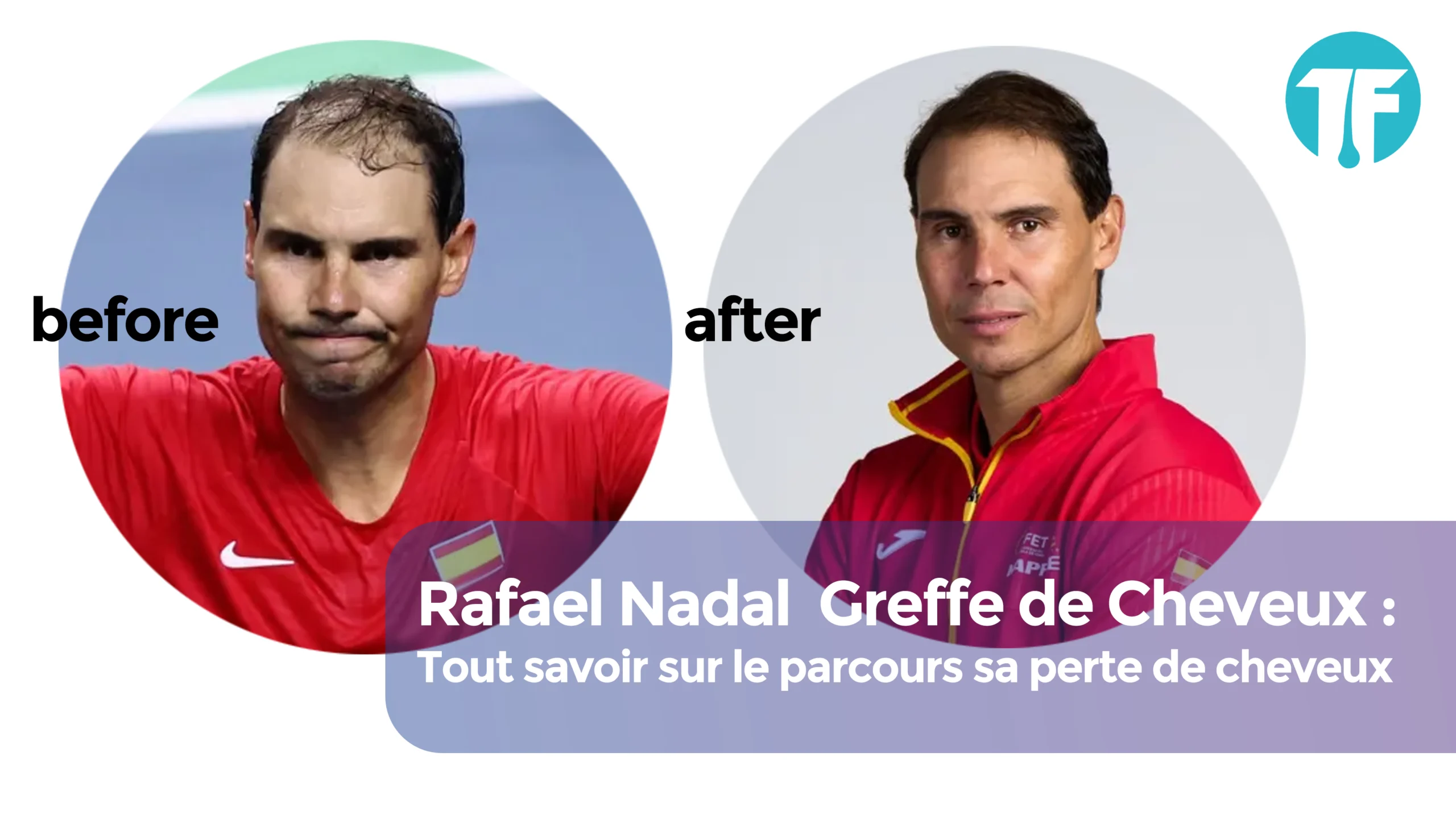 Rafael Nadal Greffe de Cheveux cover
