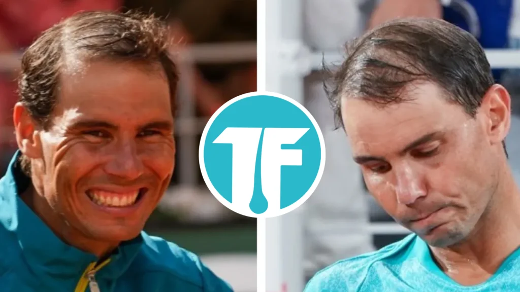 Rafael Nadal  Greffe de Cheveux 