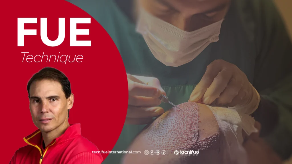 Rafael Nadal  Greffe de Cheveux FUE