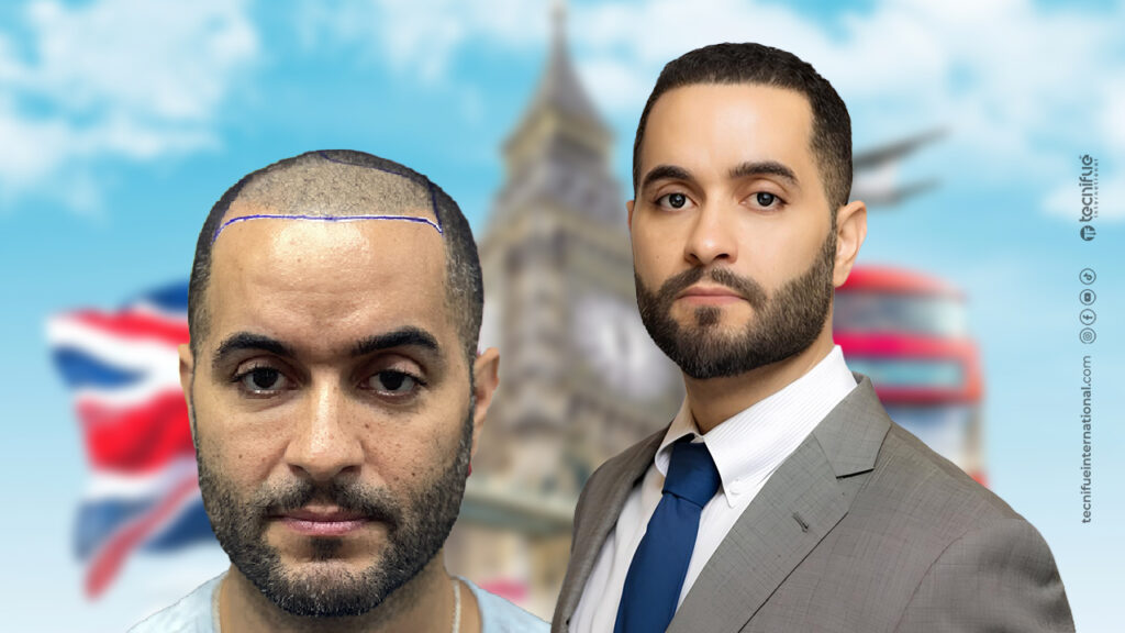 Hair Transplant turkiye before after vs UK 