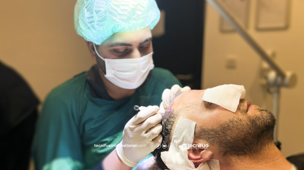 DHI Hair Transplant at Tecnifue
