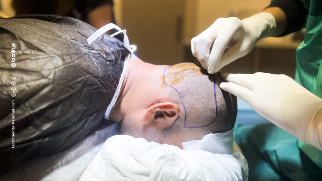 FUE hair transplant at Tecnifue