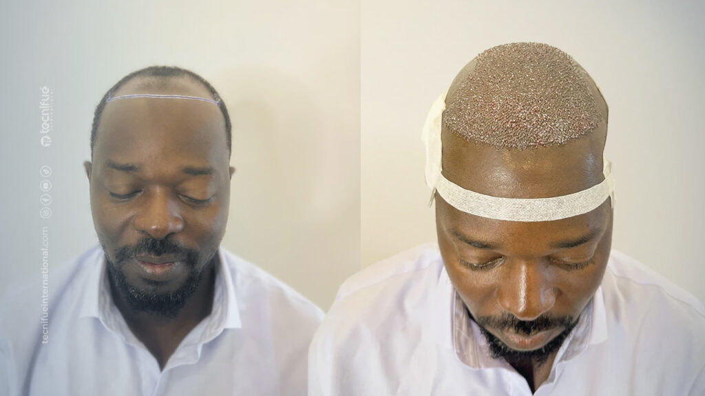 Greffe de cheveux Afro chez TecniFUE International