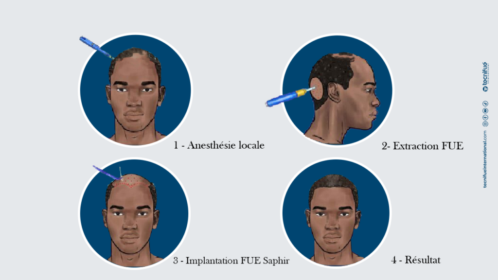 Greffe de cheveux Afro chez TecniFUE International Etapes