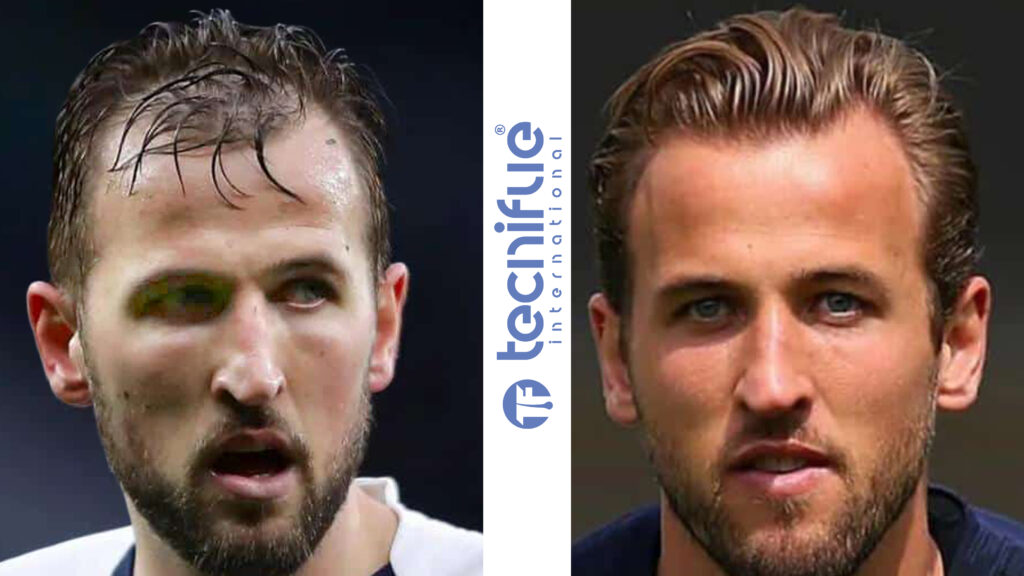 Harry Kane Hair Transplant