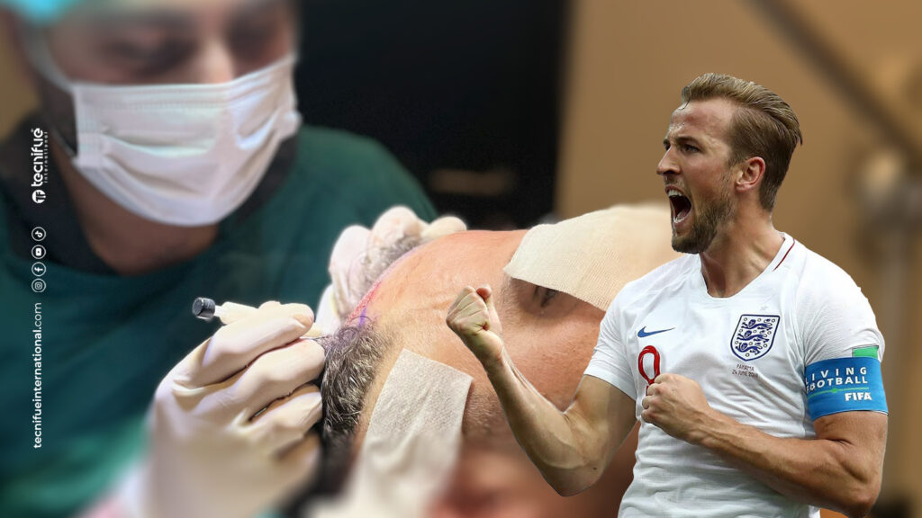 Harry Kane Hair Transplant DHI