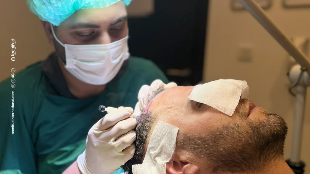 Tricopigmentation Danger greffe de cheveux