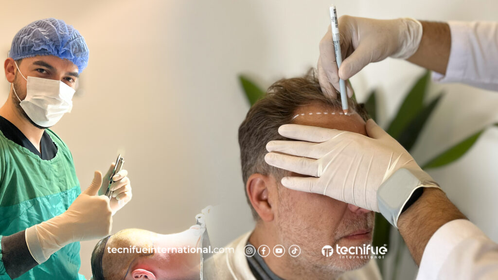Greffe de Cheveux chez TecniFUE