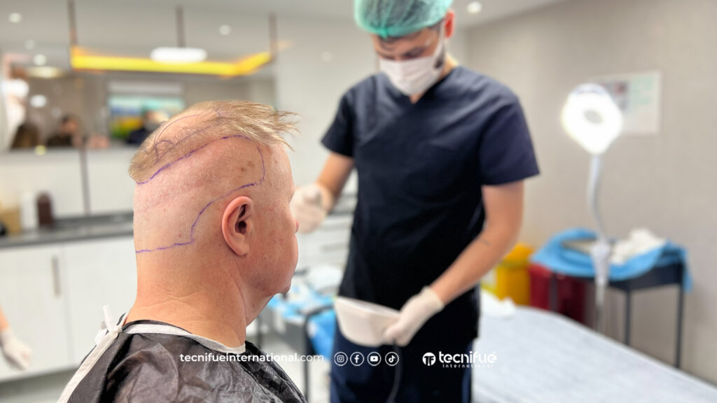Greffe de Cheveux chez TecniFUE