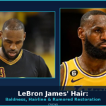 LeBron James Hair Transplant cover
