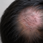 fungus on scalp