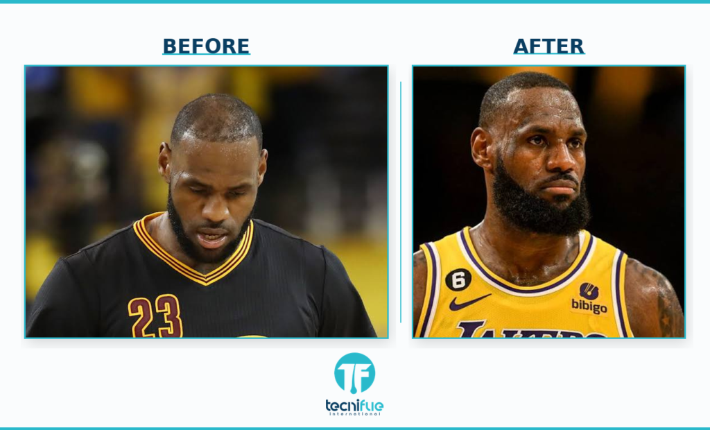LeBron James hair transplant