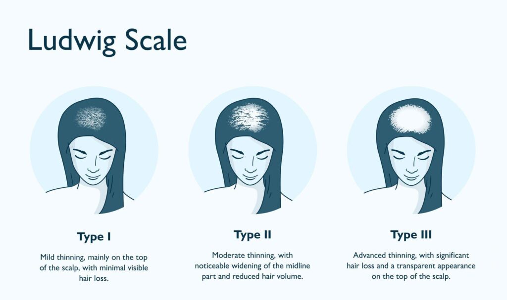Norwood and Ludwig Scales Understanding Pattern Hair Loss